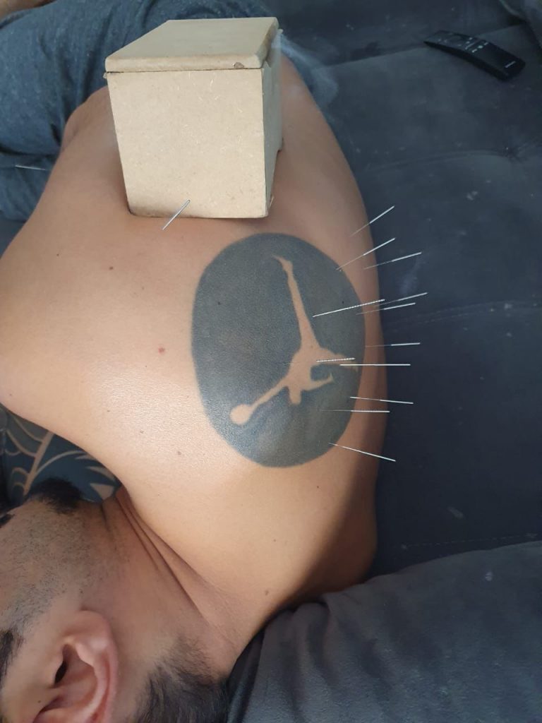 Prática de acupuntura realizada pelo especialista Ângelo Amaral